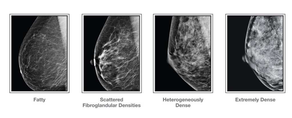 Breast Density and Early Detection - Knowledge Is The New Pink